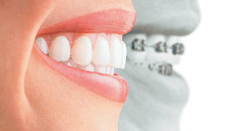 Lady wearing braces